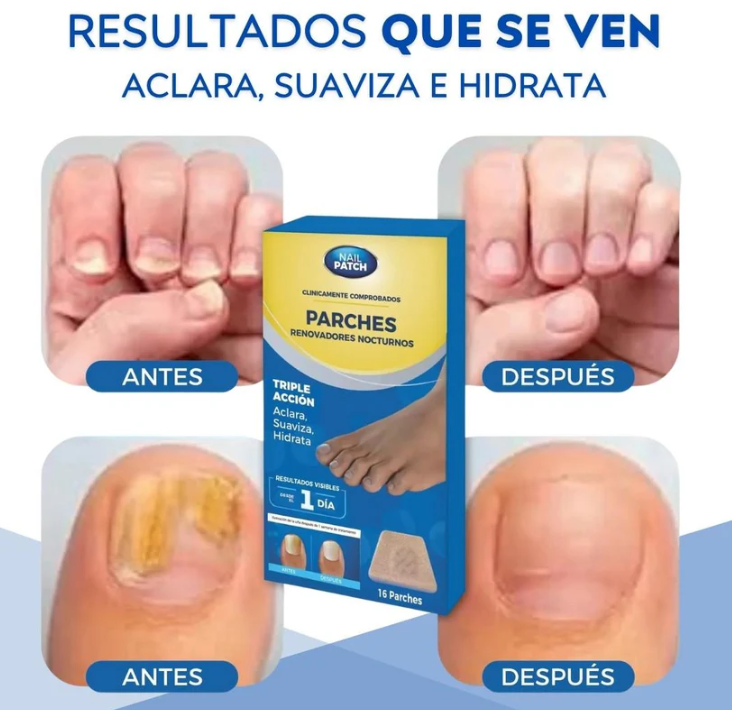 Parches Antihongo FungalNail Pro™ Elimina el Hongo en las uñas Facilmente