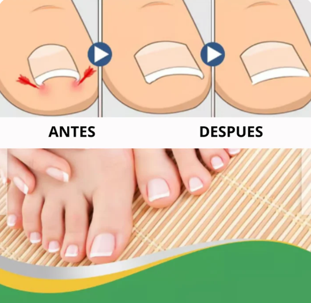 PediFix™ Parches corrector para uñas encarnadas (50 unidades)