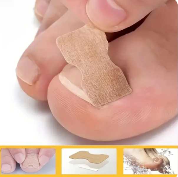 PediFix™ Parches corrector para uñas encarnadas (50 unidades)