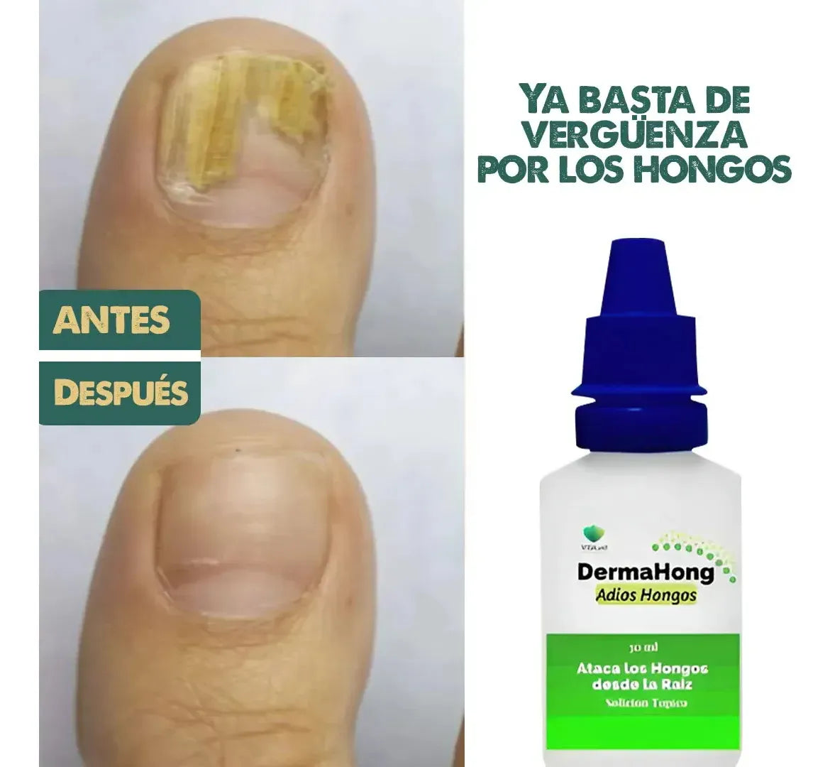 Dermahong™ Gotas Fungicidas Anti- Hongos ( Oferta Dieciochera 3x1)