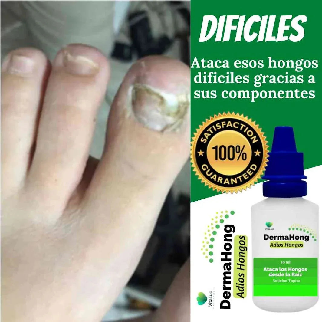 Dermahong™ Gotas Fungicidas Anti- Hongos ( Oferta Dieciochera 3x1)