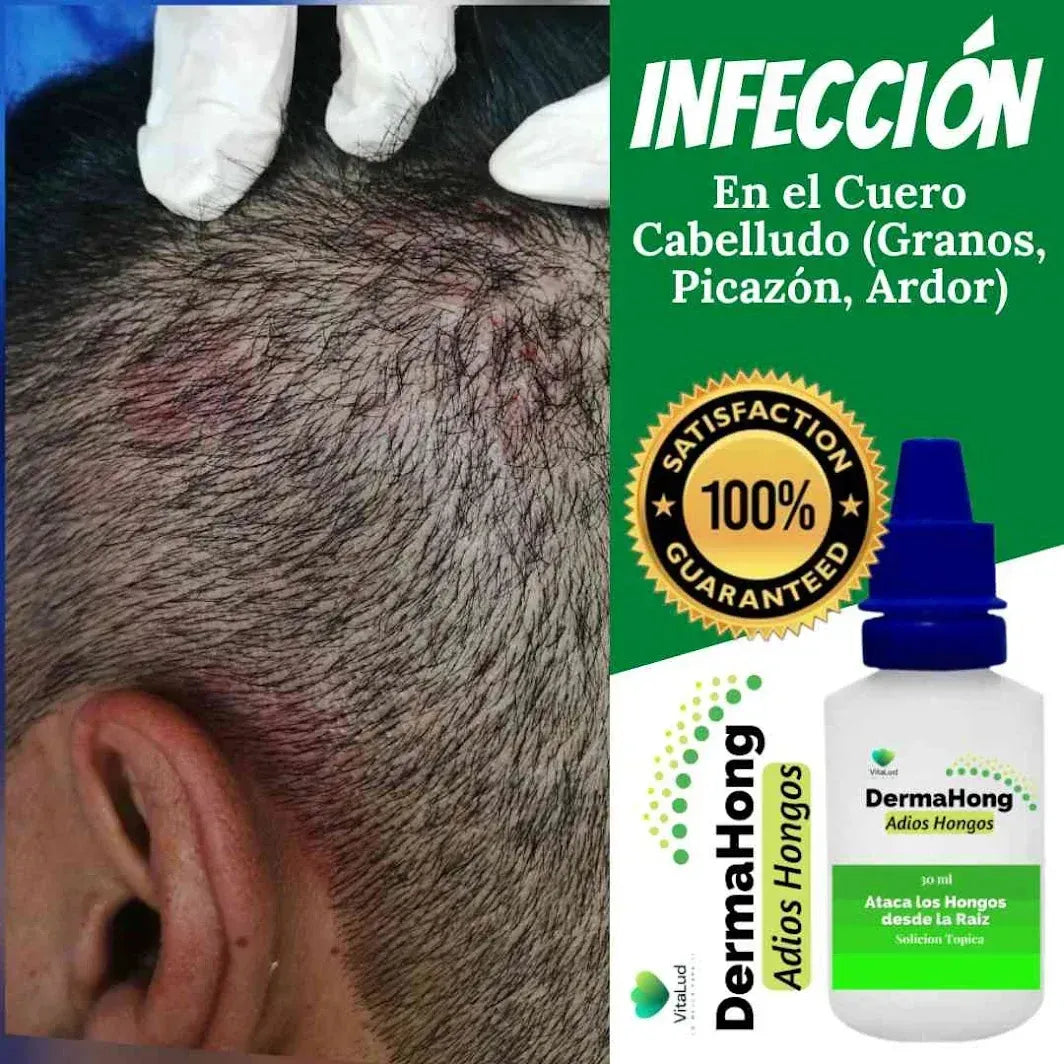 Dermahong™ Gotas Fungicidas Anti- Hongos ( Oferta Dieciochera 3x1)