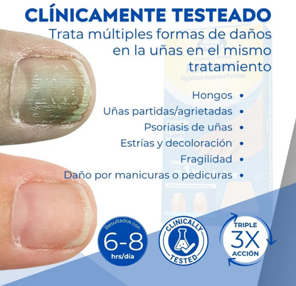 Parches Antihongo FungalNail Pro™  Elimina el Hongo en las uñas Facilmente