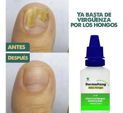 Dermahong™  Gotas Fungicidas Anti- Hongos ( Oferta Dieciochera 3x1)